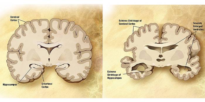 Здоровый мозг и мозг, пораженный болезнью Альцгеймера