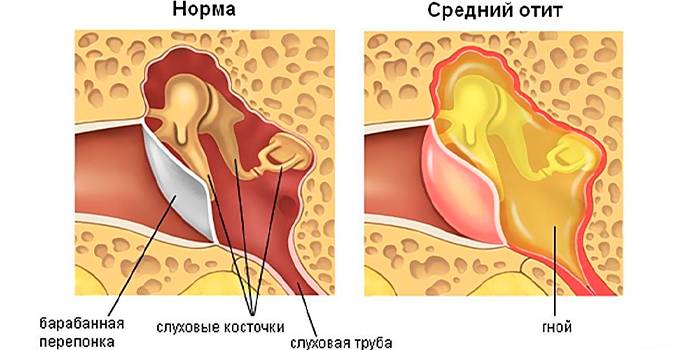 Средний отит