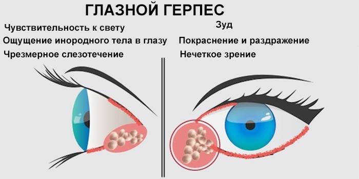 Симптоматика глазного герпеса