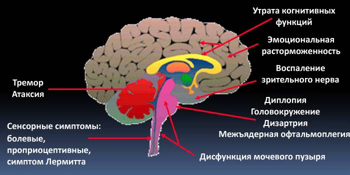 Поражение частей мозга, которые вызывают симптомы РС