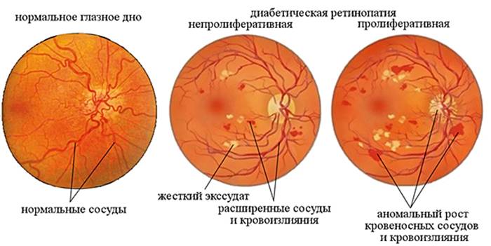 Диабетическая ретинопатия 