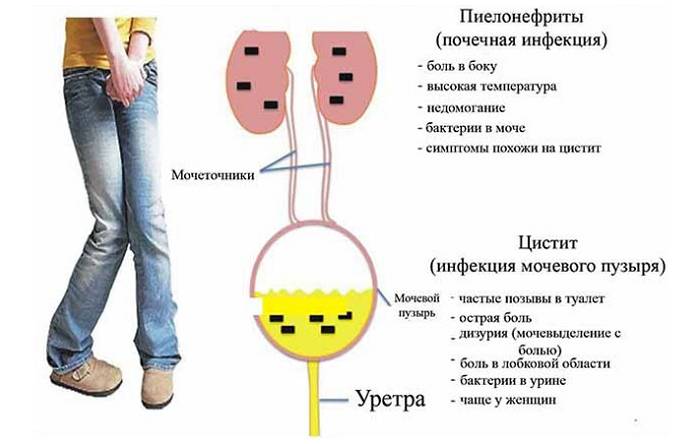 Симптомы инфекций мочевыводящих путей