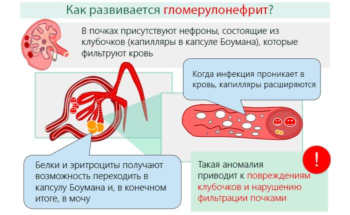 Как развивается гломерулонефрит