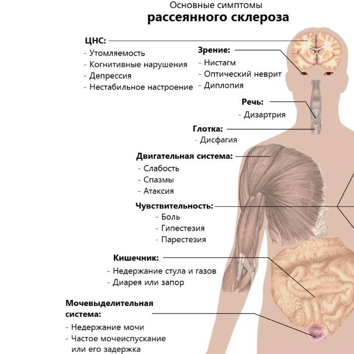 Симптомы рассеянного склероза