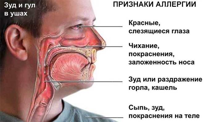 Симптомы аллергии 