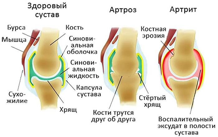 Артроз и артрит сустава