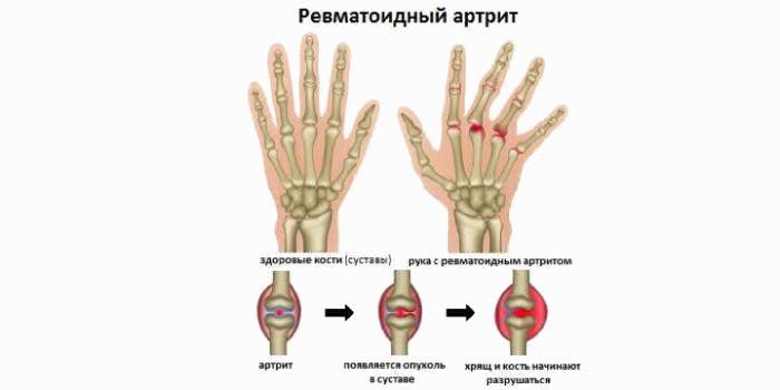 Ревматоидный артрит на кистях рук