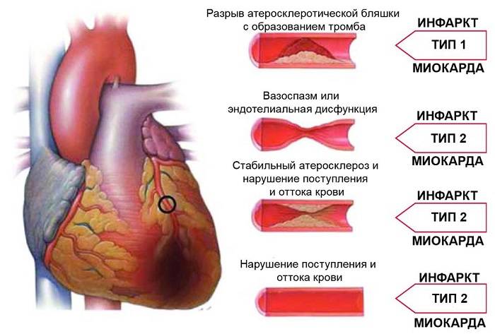 Как возникает инфаркт