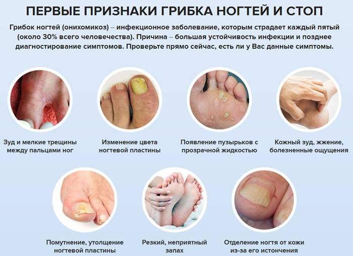 Первые признаки грибка ногтей и стоп