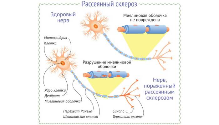 Нервы, пораженные рассеянным склерозом