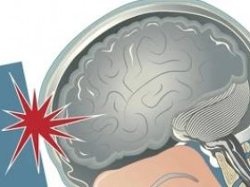 Что такое сотрясение мозга