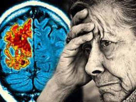 6 шагов, снижающих риск развития деменции