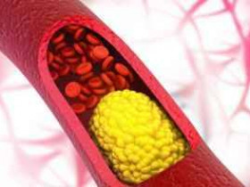 8 шагов для снижения уровня холестерина в крови