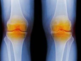 Разница между остеоартритом и ревматоидным артритом