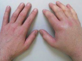 9 причин, по которым у вас опухают пальцы