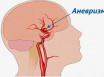 9 симптомов аневризмы головного мозга