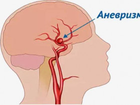 9 симптомов аневризмы головного мозга