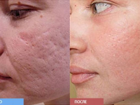 4 способа избавиться от шрамов от угревой сыпи на лице