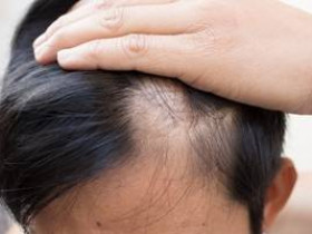 Может ли дефицит витамина D вызвать у вас выпадение волос