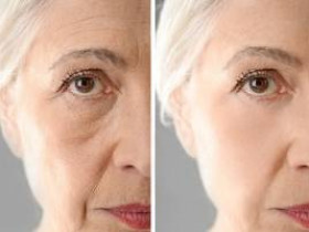 8 нехирургических способов устранения признаков старения