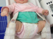 Дисплазия тазобедренного сустава у новорожденных