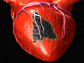 8 предупреждающих признаков инфаркта у женщин