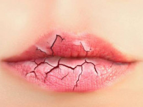 7 симптомов, о которых говорят потрескавшиеся губы