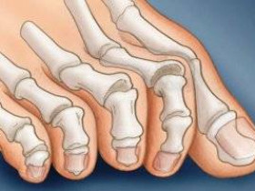 5 вещей, которые необходимо знать о деформации пальцев стопы